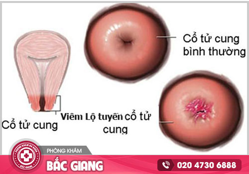 Viêm lộ tuyến là bệnh gì? Có nguy hiểm không?