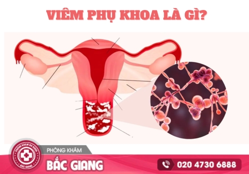 viêm phụ khoa
