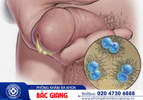 Xét nghiệm bệnh lậu gồm các xét nghiệm nào?