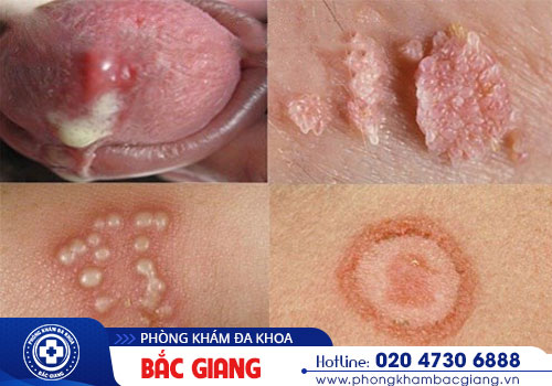 Xét nghiệm bệnh xã hội gồm các xét nghiệm gì?