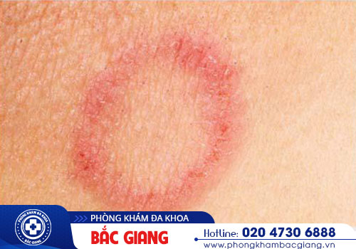 Xét nghiệm giang mai ở đâu uy tín?