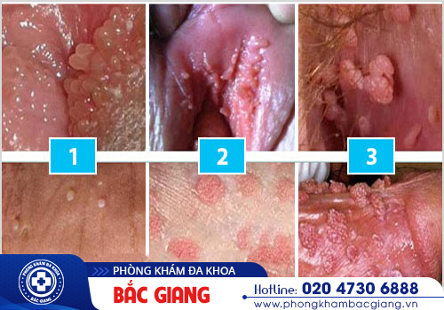 Xét nghiệm HPV có đắt không, độ chính xác, thời gian trả kết quả?