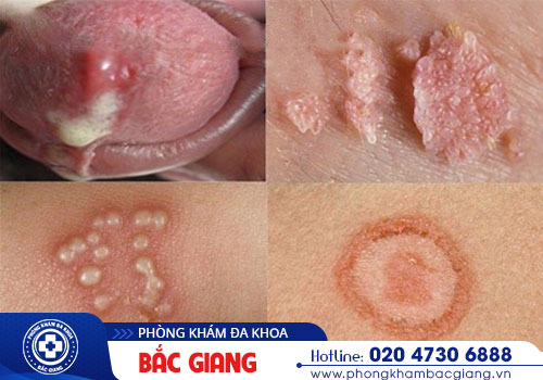 Xét nghiệm nhanh bệnh xã hội ở đâu uy tín?