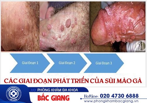 Xét nghiệm sùi mào gà ở đâu uy tín, giá rẻ, kết quả nhanh chóng?